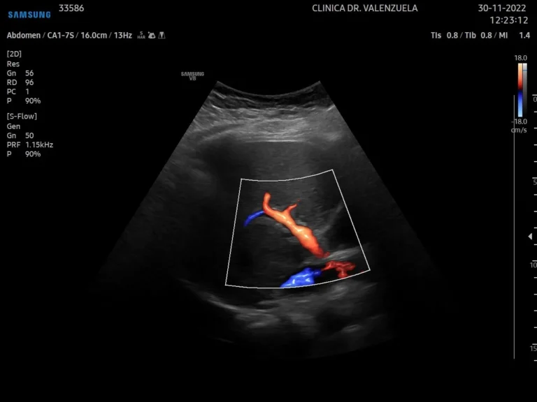 Ecografía Doppler abdominal con visualización de flujo sanguíneo en vasos intraabdominales