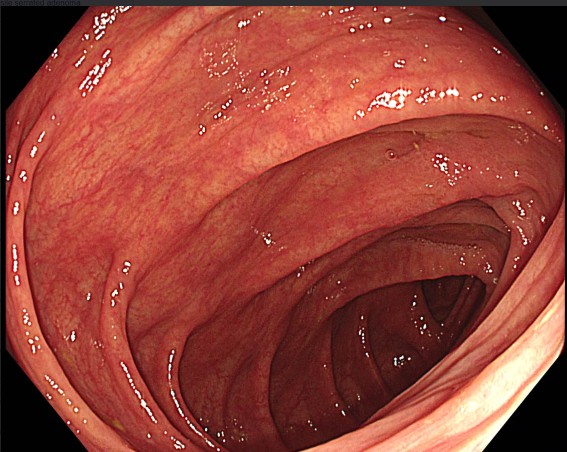 Colonoscopia